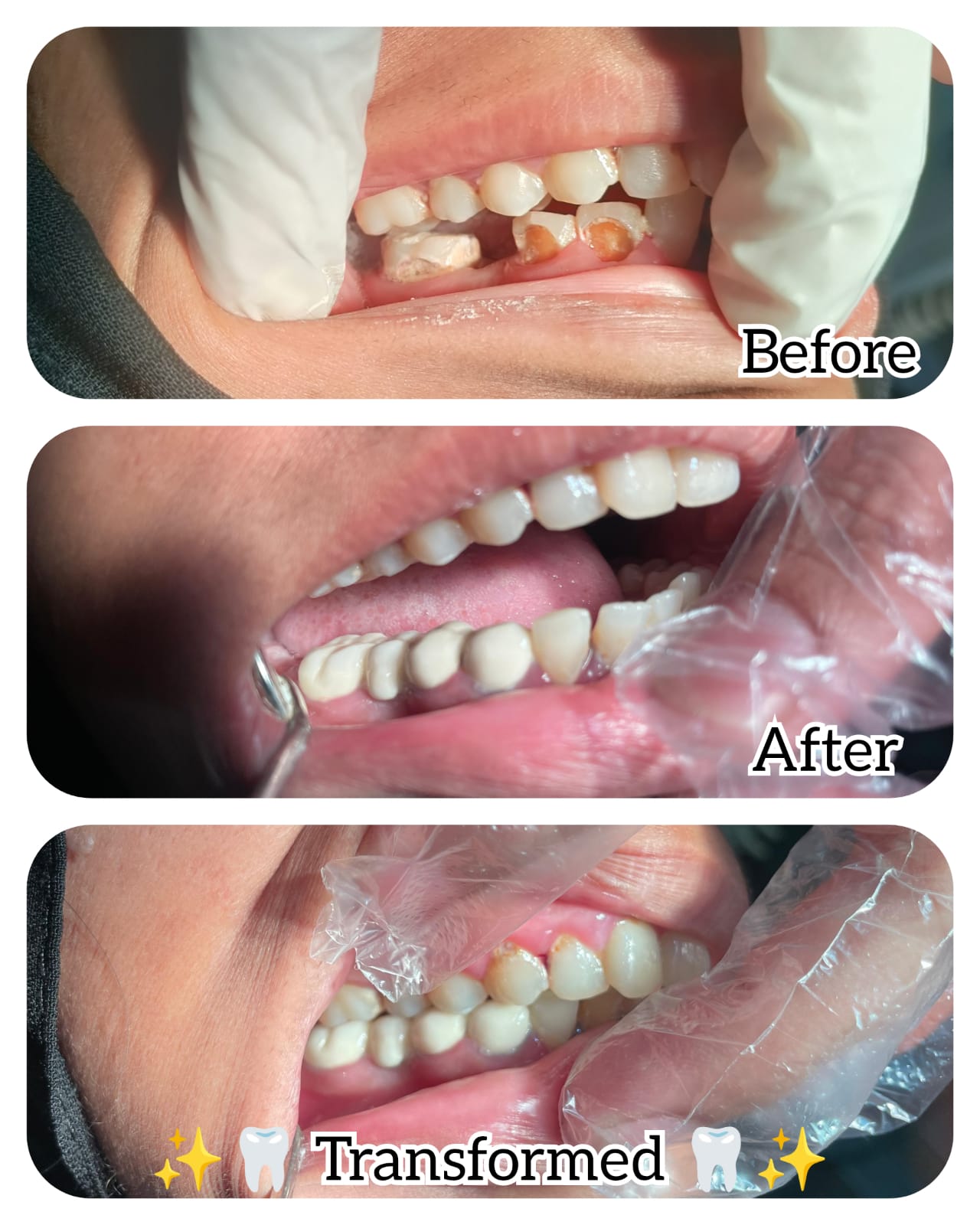 Crown restoration before and after case