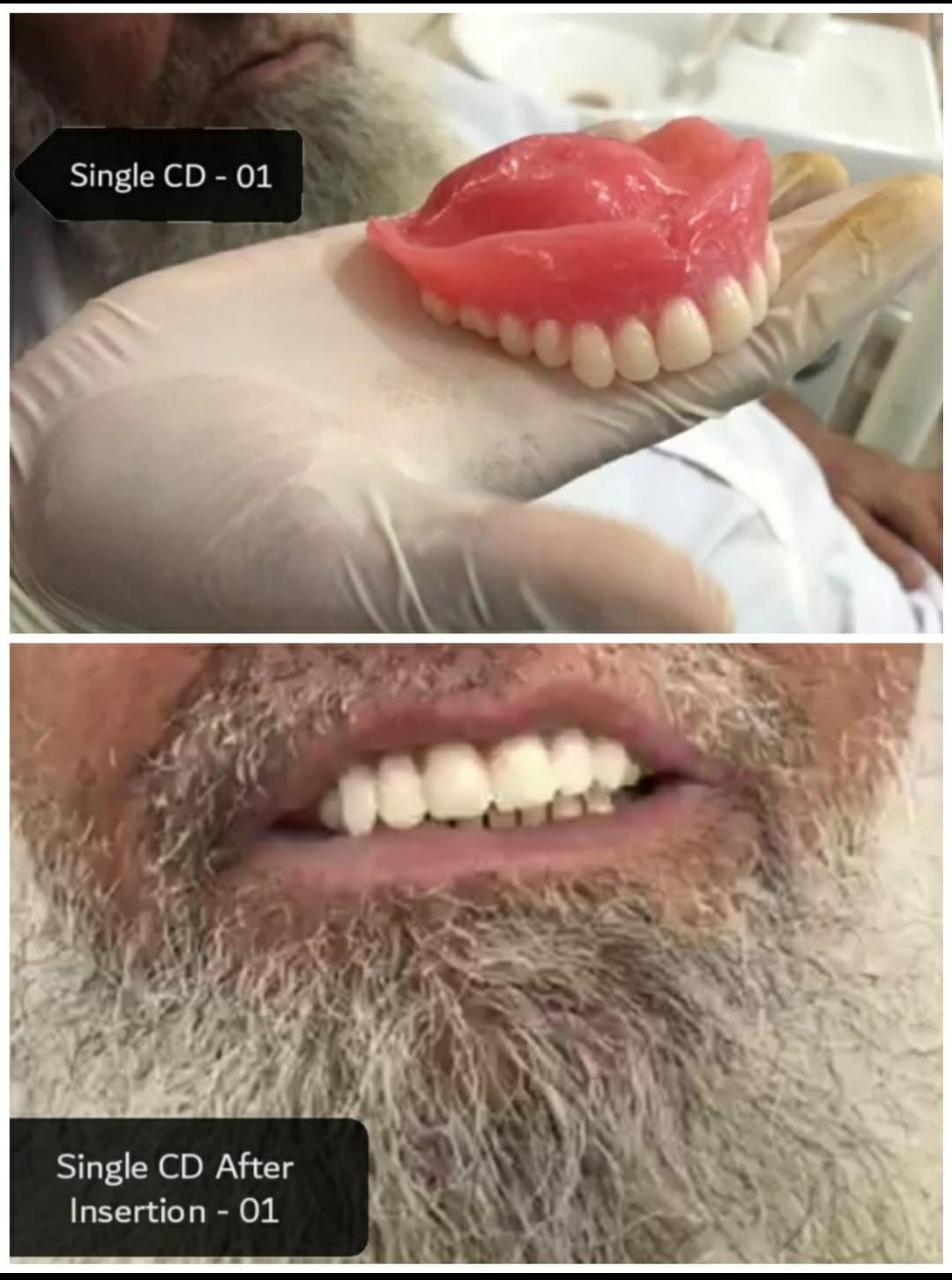 Complete denture before and after case