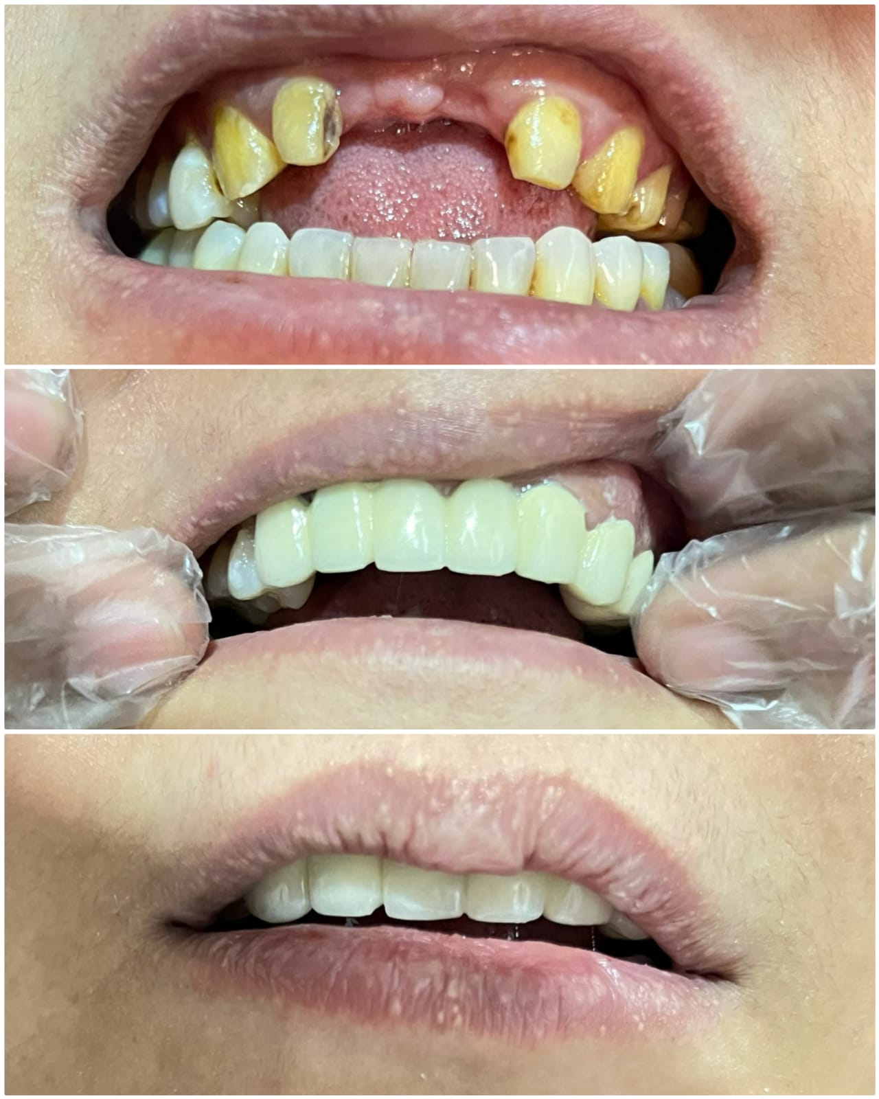 Full arch rehabilitation before and after case