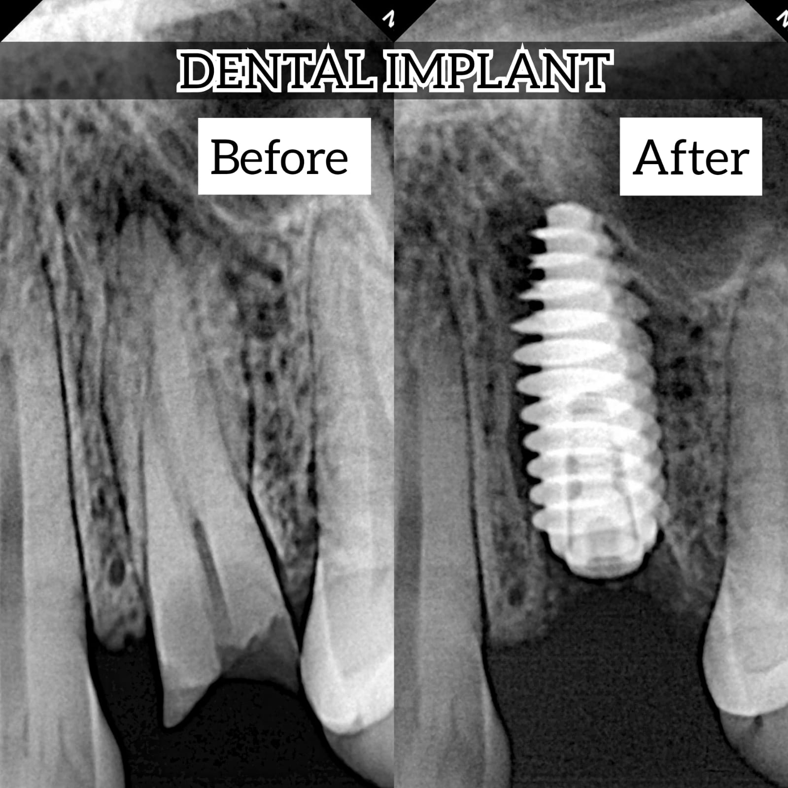 Dental implant before and after X-ray
