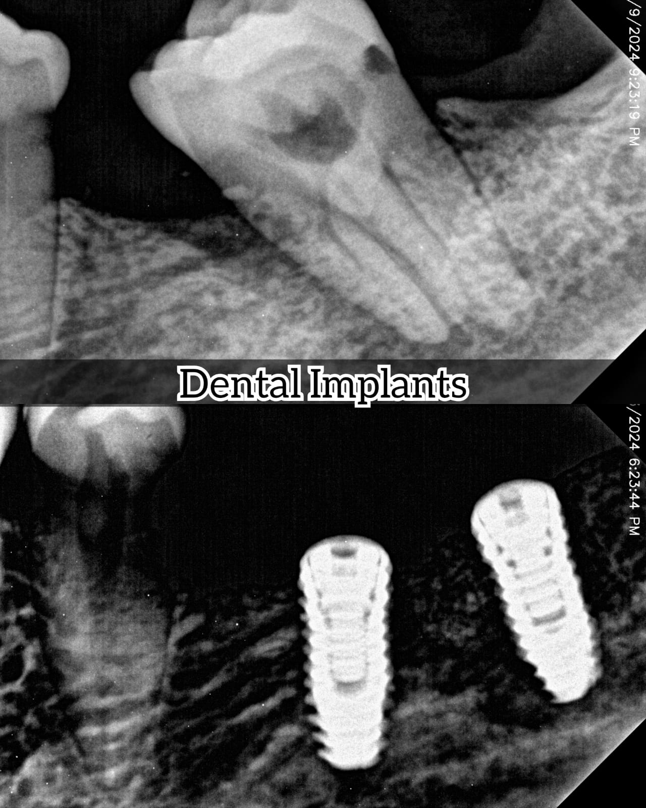 Implant-supported restoration X-ray case
