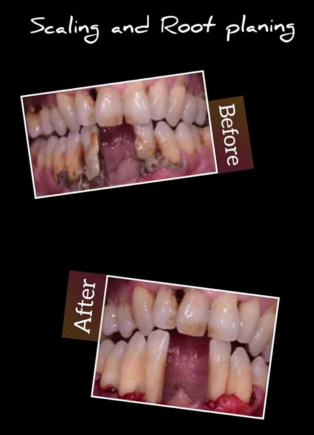 Scaling and root planing before and after