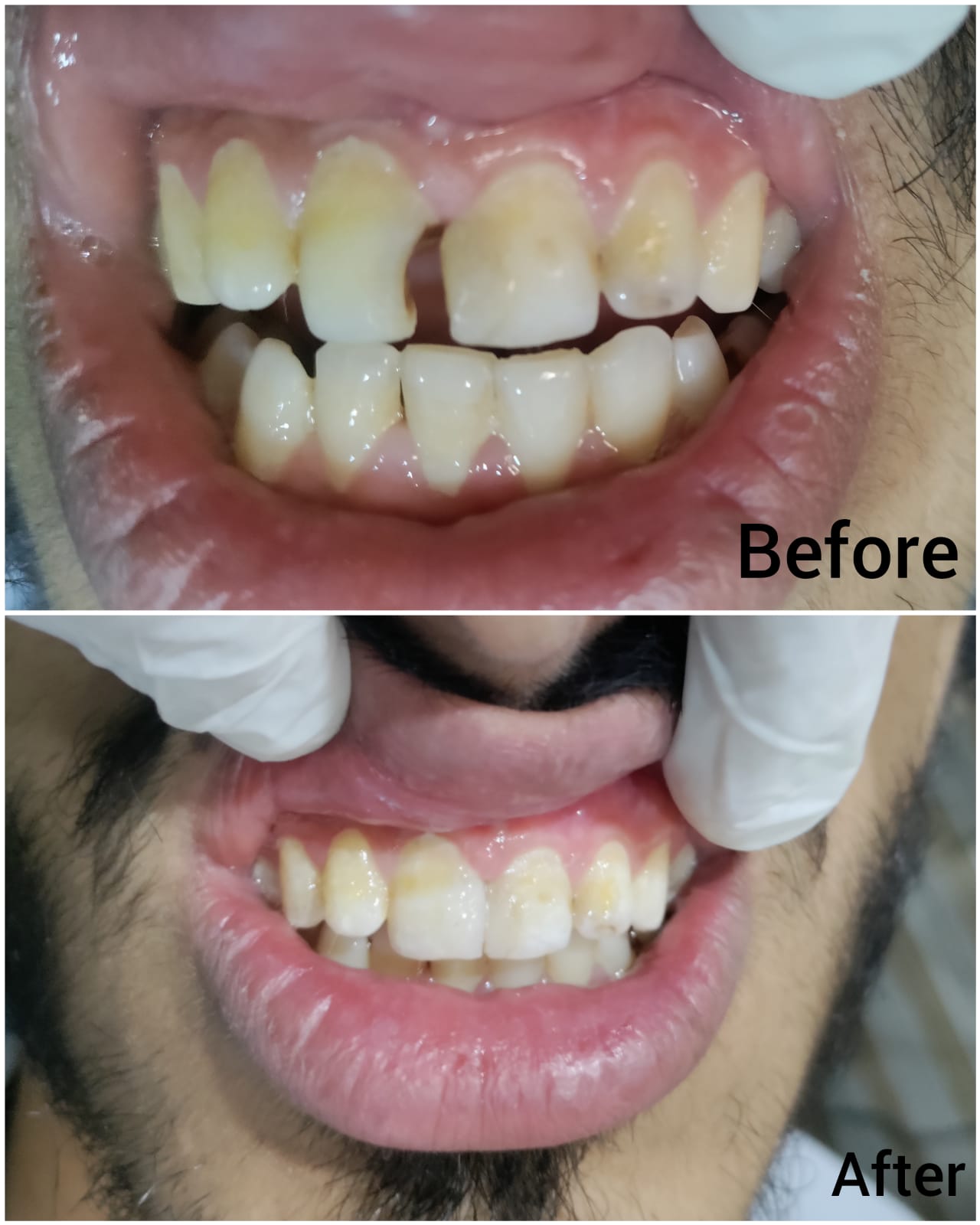 Smile rehabilitation before and after case