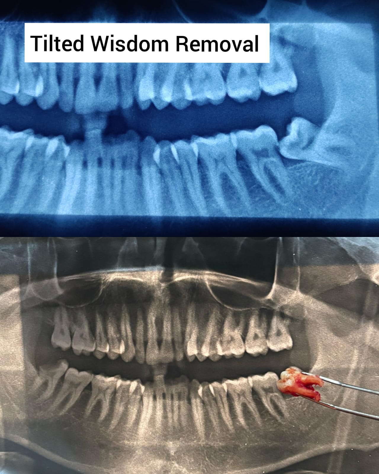 Wisdom tooth removal X-ray case