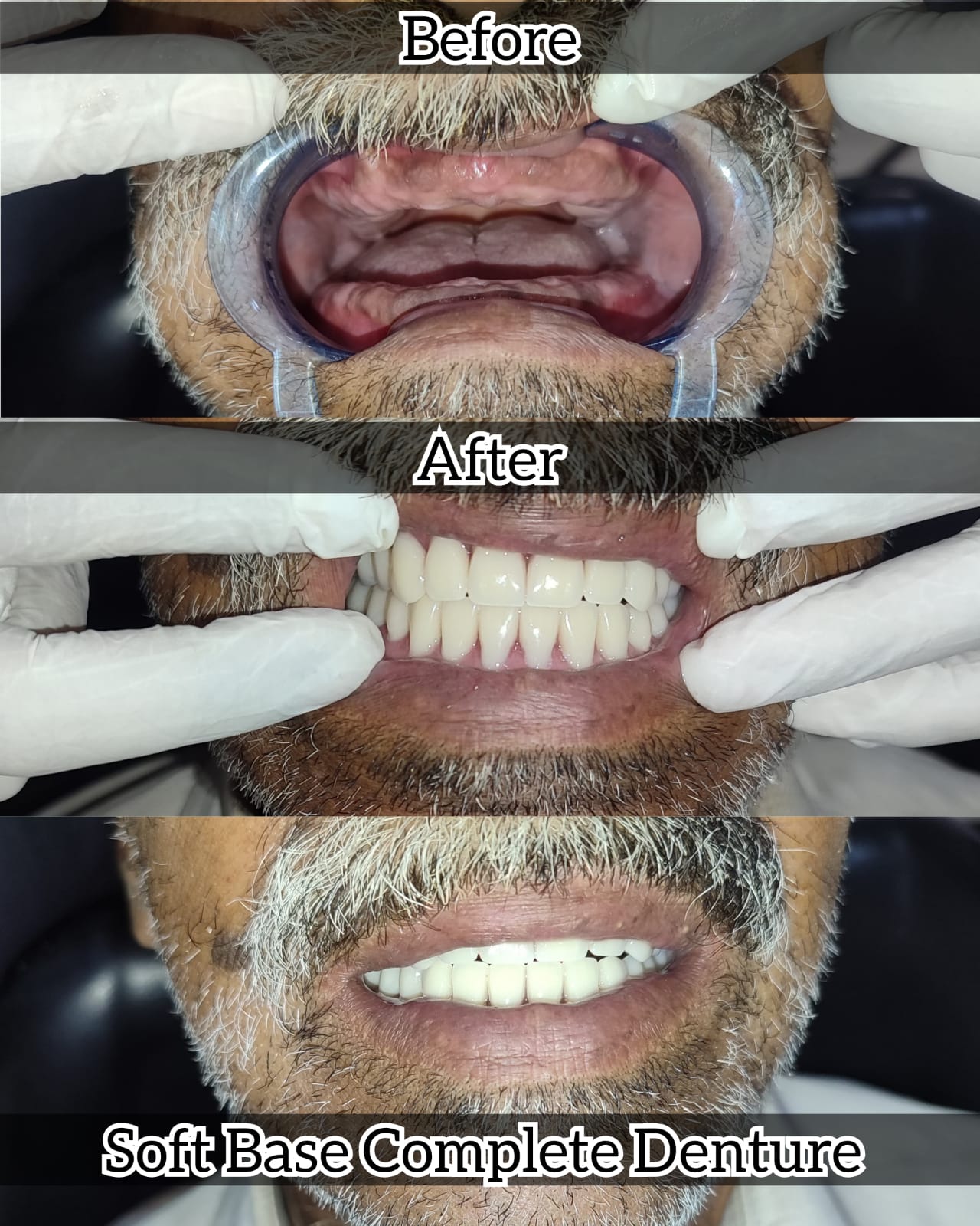 Full mouth complete denture case